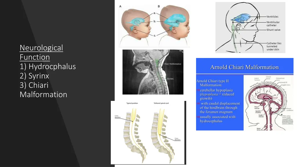 neurological function 1 hydrocphalus 2 syrinx