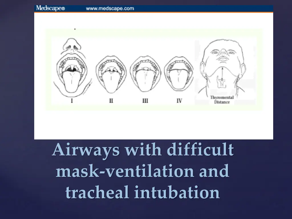 airways with difficult mask ventilation