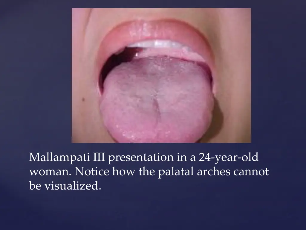 mallampati iii presentation in a 24 year