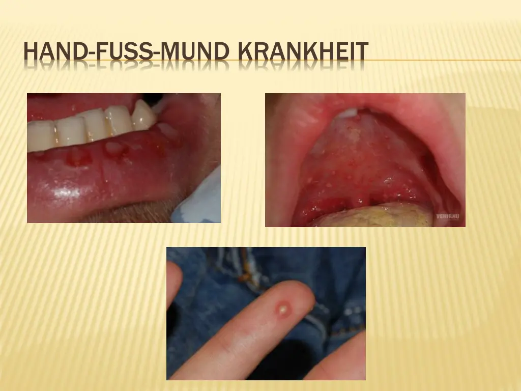 hand fuss mund krankheit 1