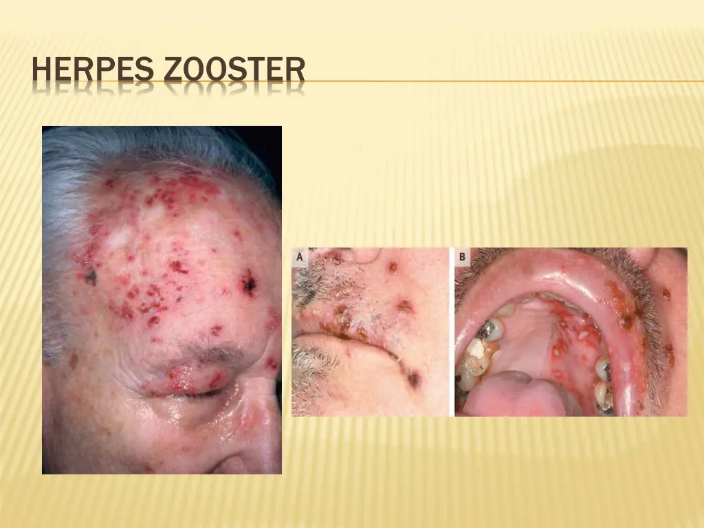 herpes zooster