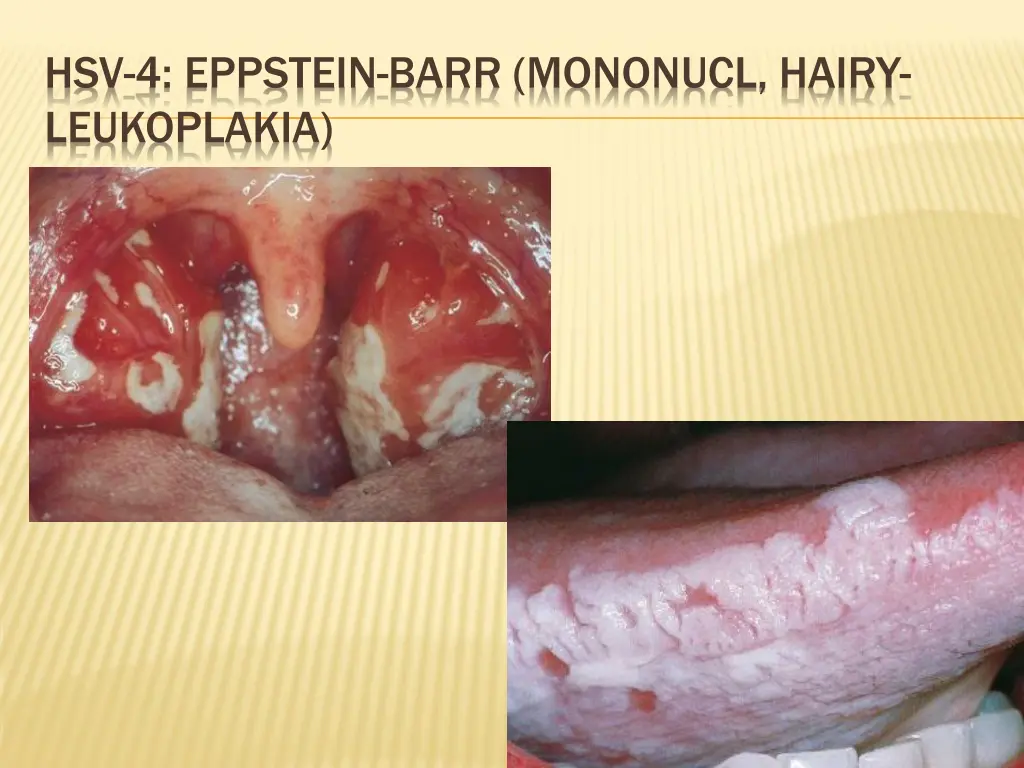 hsv 4 eppstein barr mononucl hairy leukoplakia