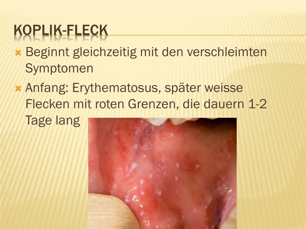koplik fleck