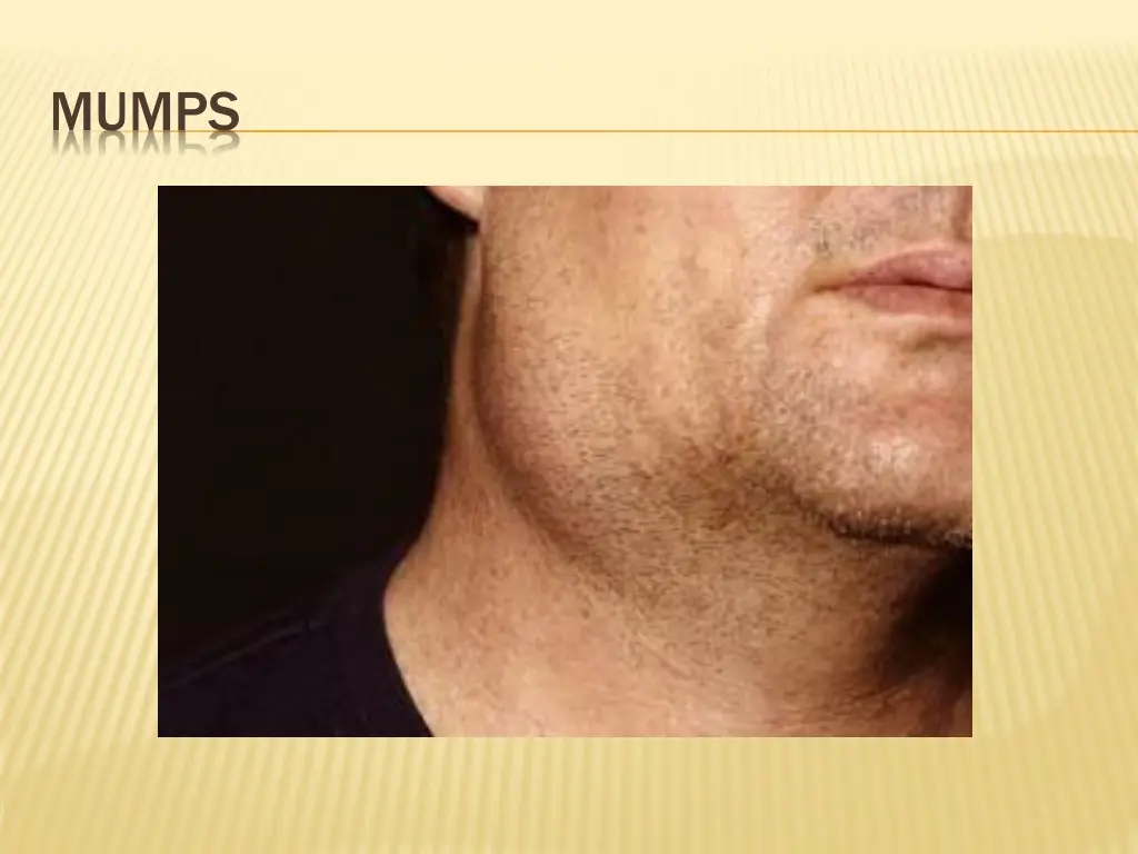 mumps