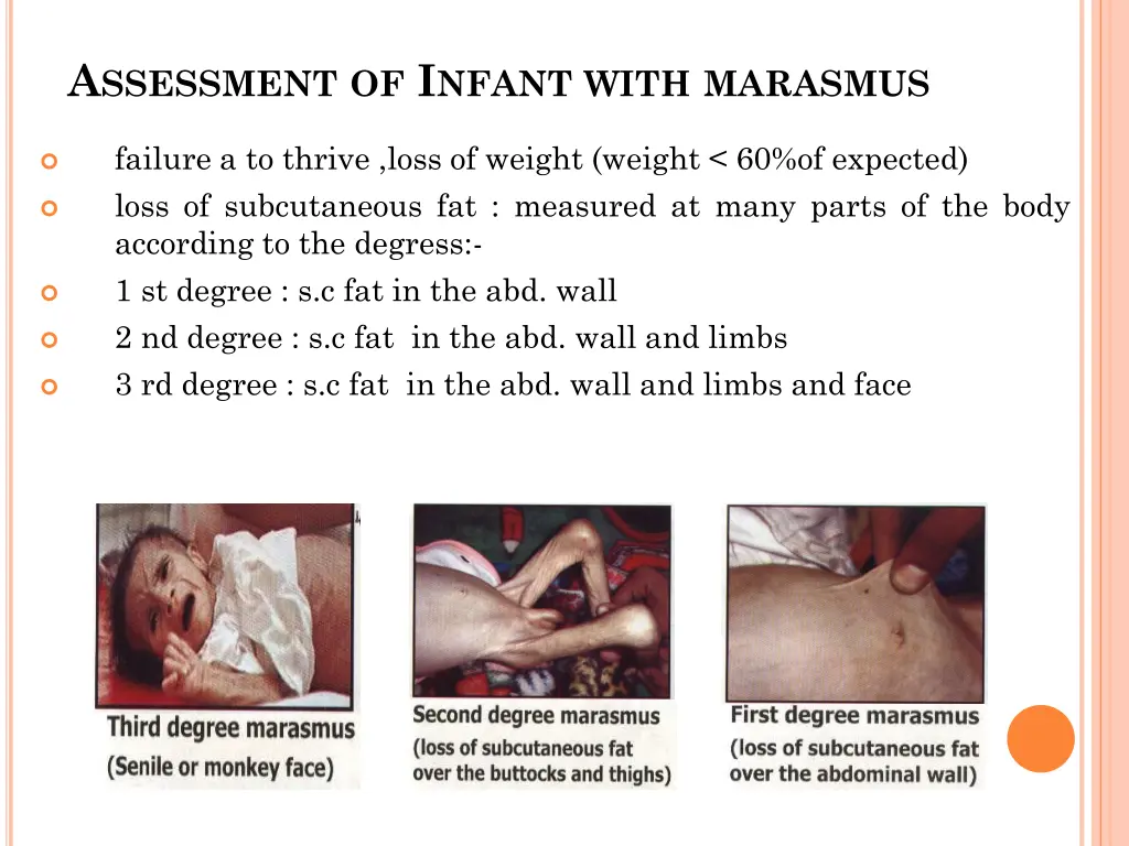 a ssessment of i nfant with marasmus