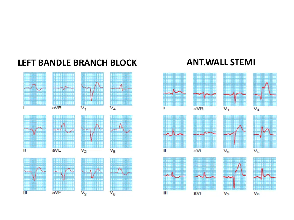 ant wall stemi