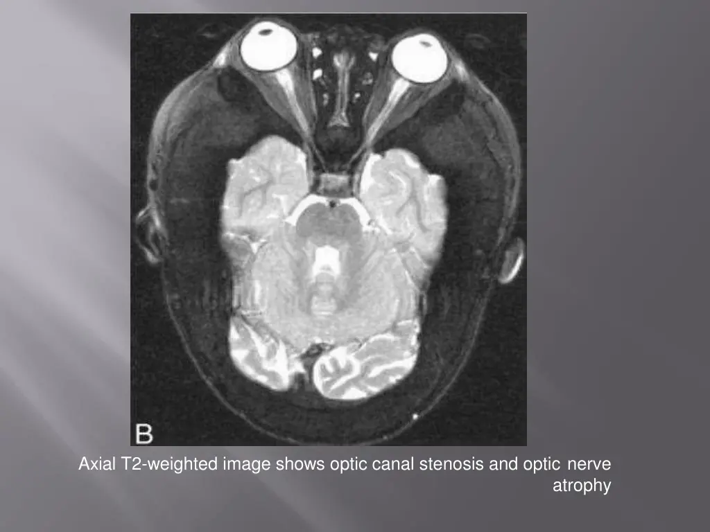 axial t2 weighted image shows optic canal