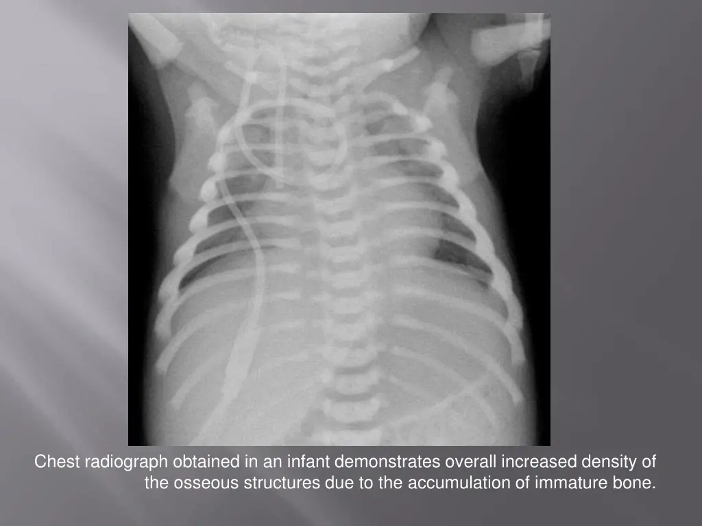 chest radiograph obtained in an infant