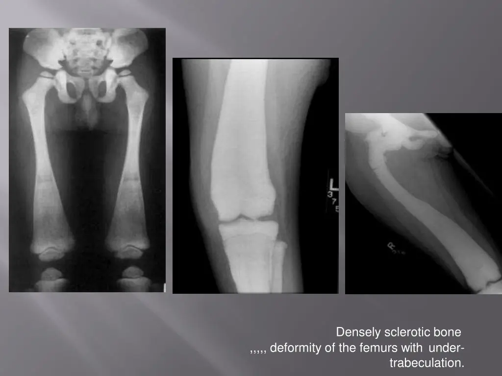 densely sclerotic bone