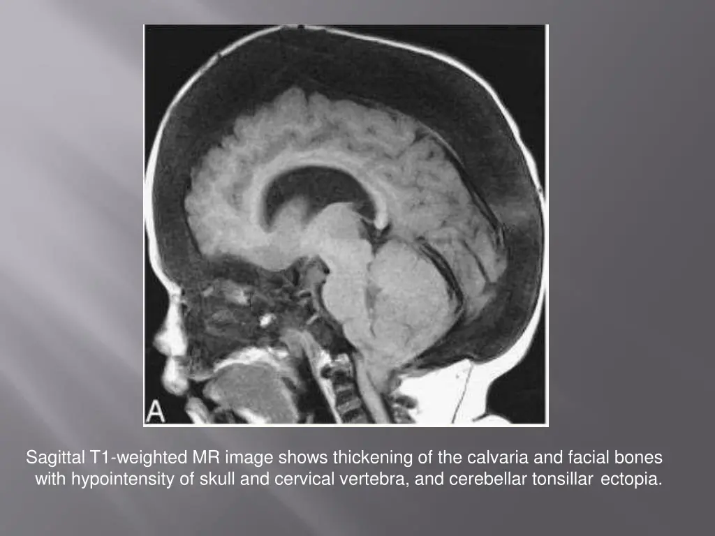 sagittal t1 weighted mr image shows thickening