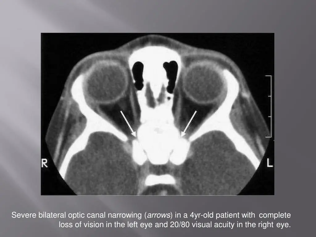 severe bilateral optic canal narrowing arrows