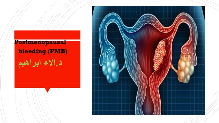 postmenopausal bleeding pmb