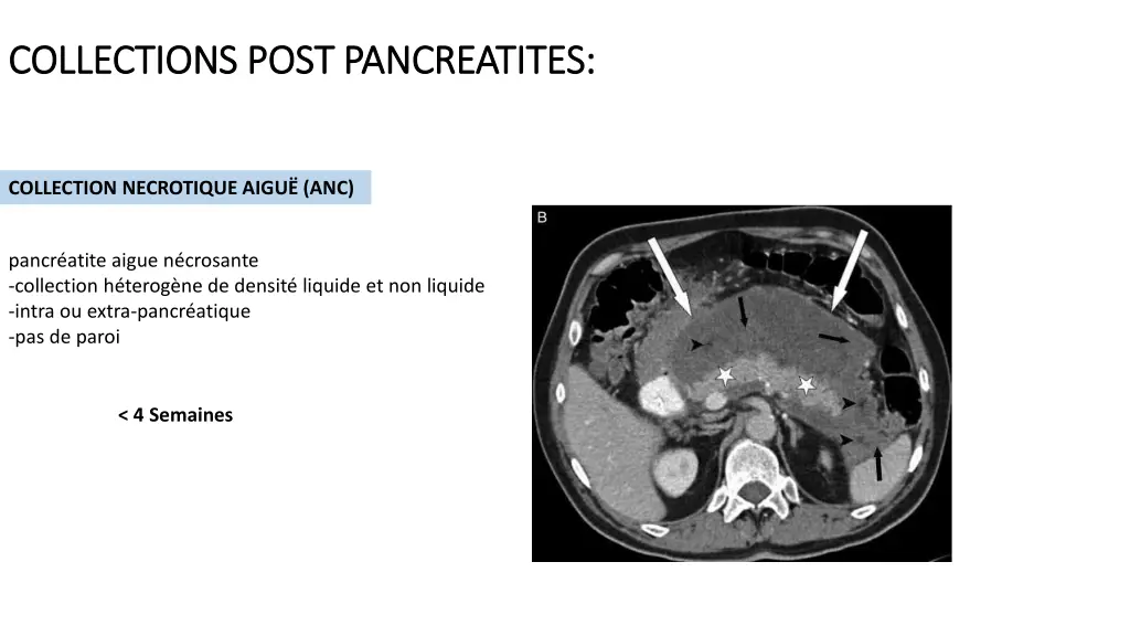 collections collections post pancreatites post 1