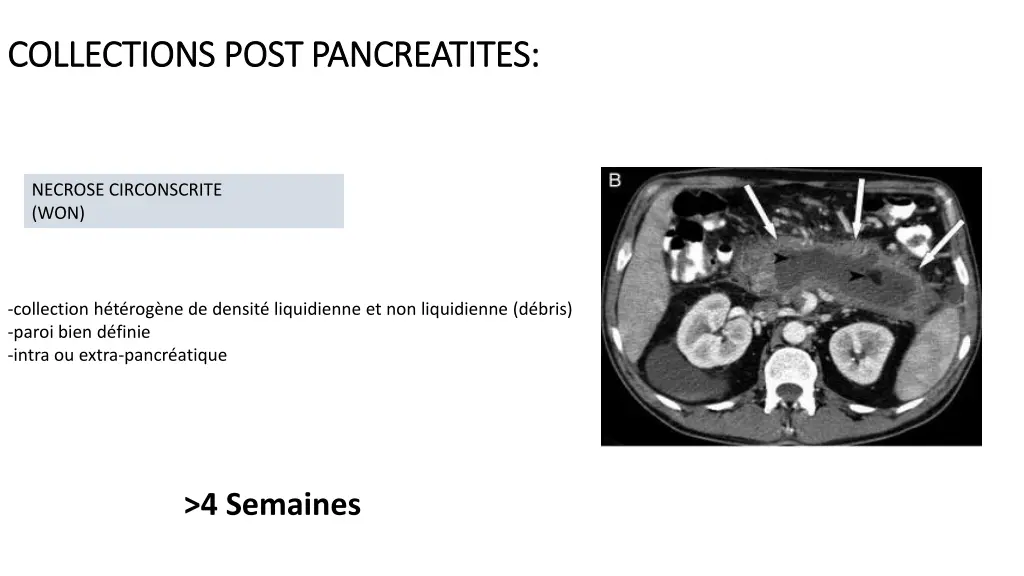 collections collections post pancreatites post 2