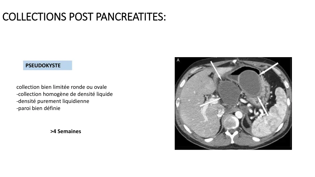 collections collections post pancreatites post 3