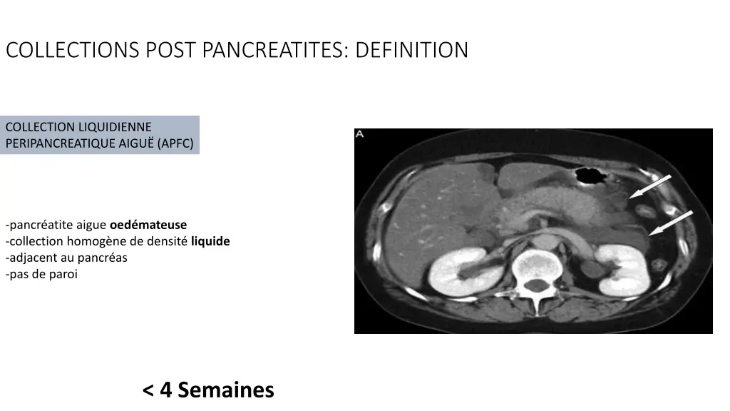 collections post pancreatites definition