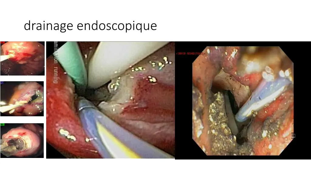 drainage endoscopique