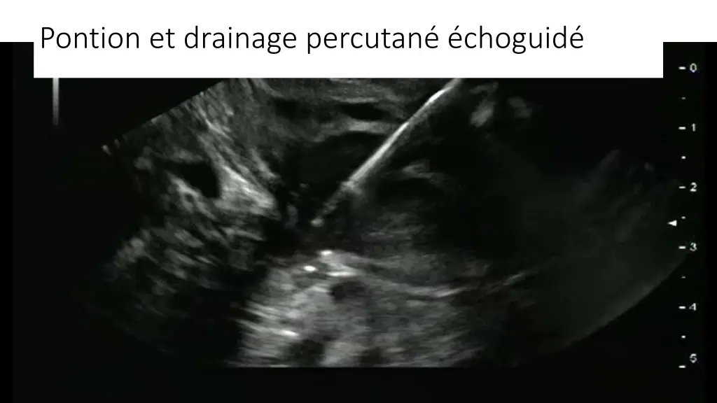 pontion et drainage percutan choguid