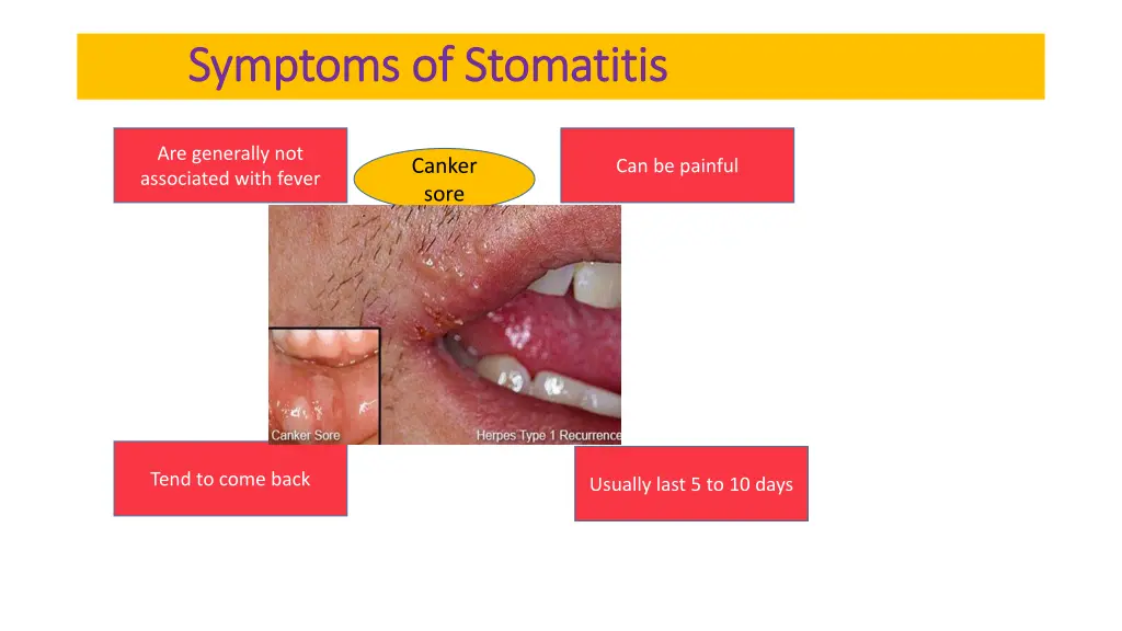symptoms of stomatitis symptoms of stomatitis