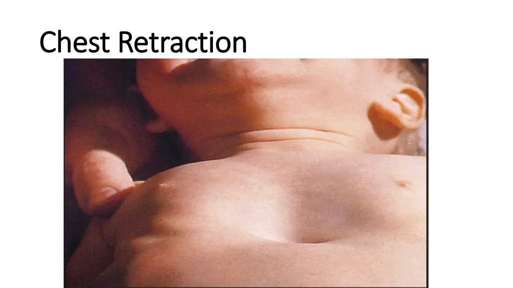 chest retraction chest retraction
