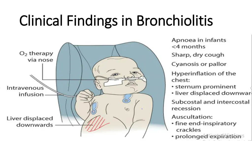 clinical findings in bronchiolitis clinical