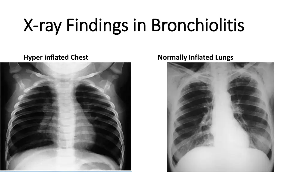 x x ray findings in bronchiolitis ray findings