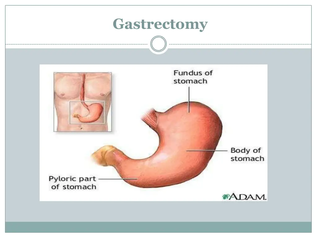 gastrectomy