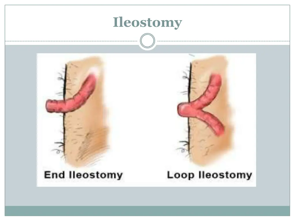 ileostomy