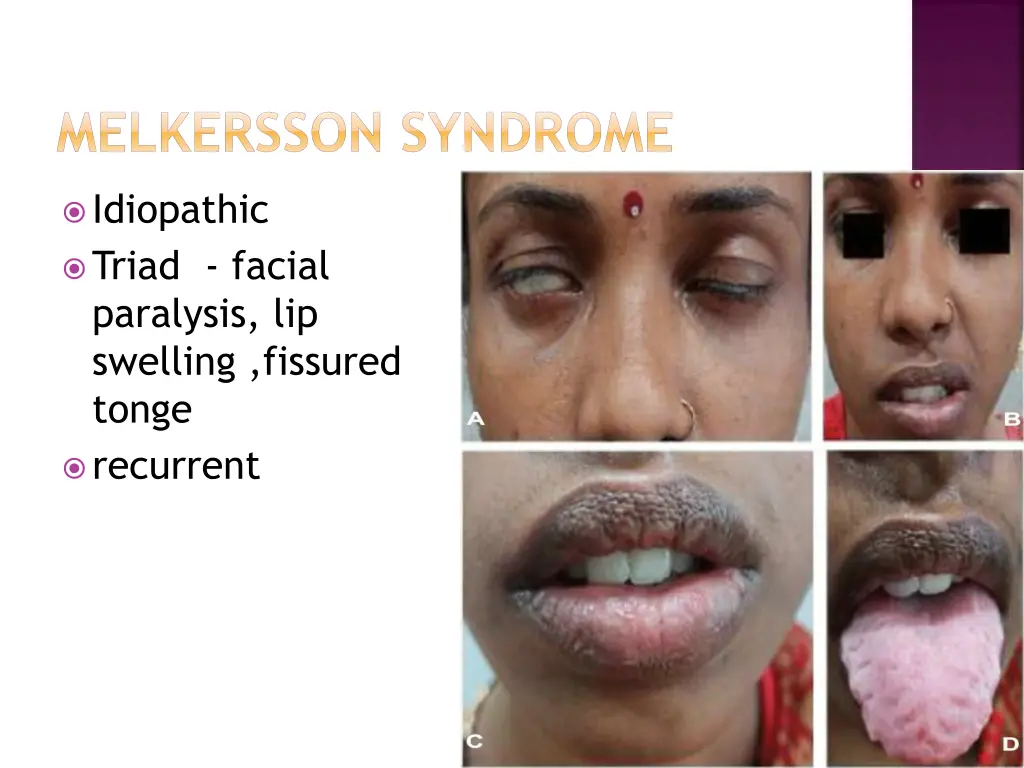 melkersson syndrome