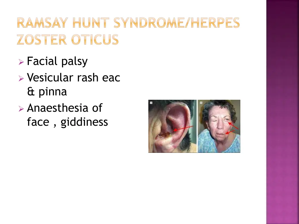 ramsay hunt syndrome herpes zoster oticus