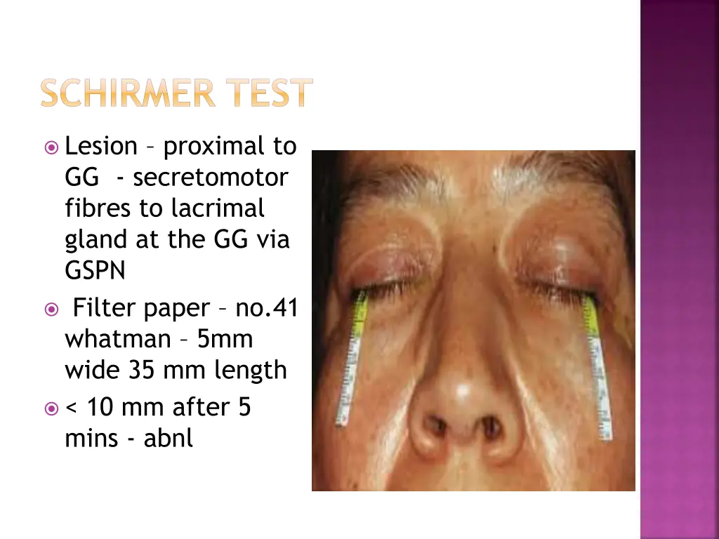 schirmer test