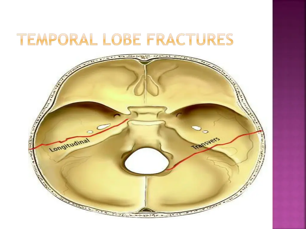 temporal lobe fractures