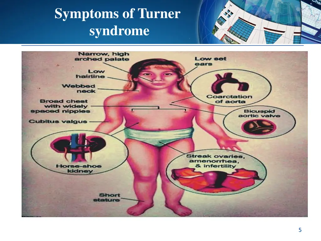 symptoms of turner syndrome