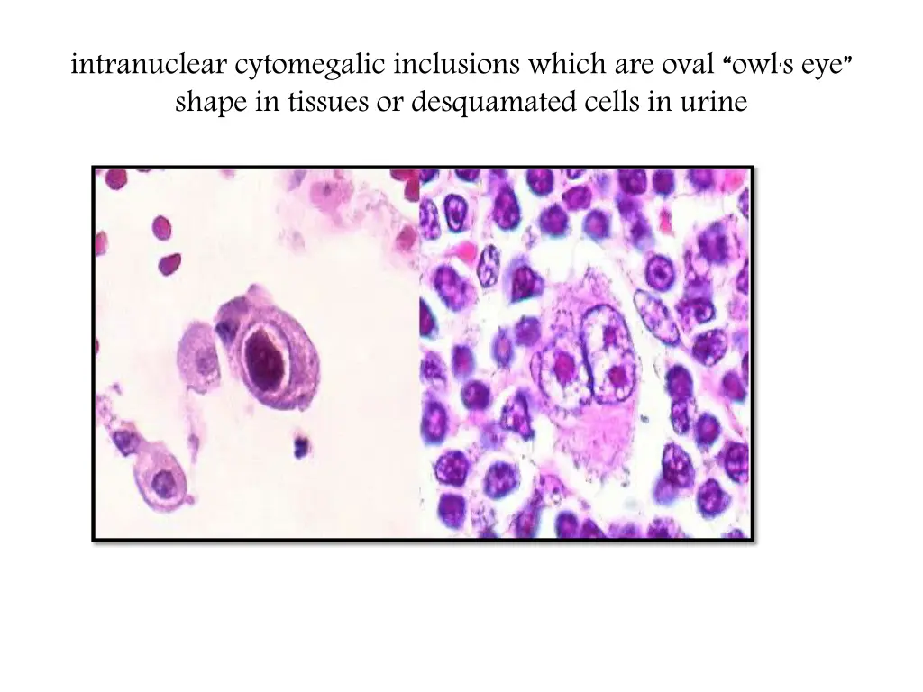 intranuclear cytomegalic inclusions which 1