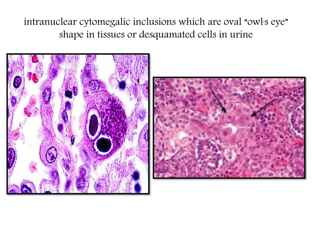 intranuclear cytomegalic inclusions which