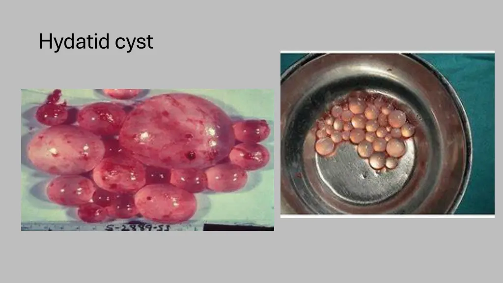hydatid cyst