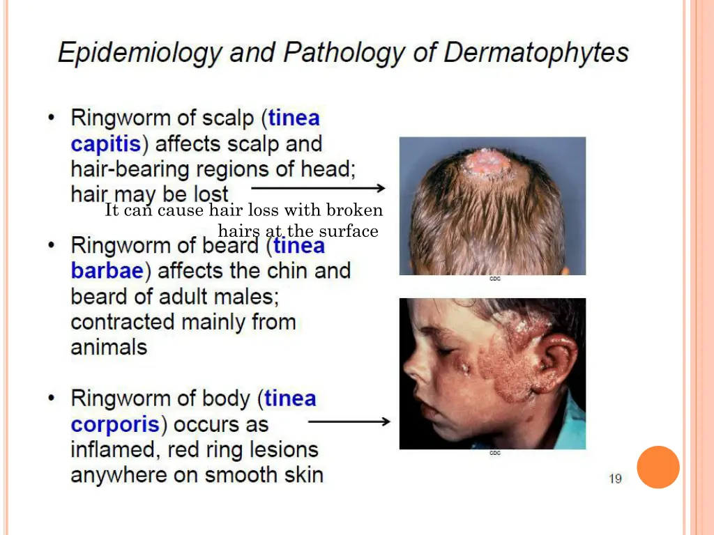 it can cause hair loss with broken hairs