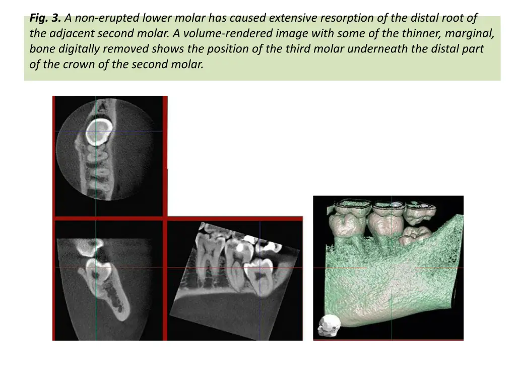 fig 3 a non erupted lower molar has caused