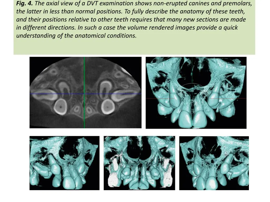 fig 4 the axial view of a dvt examination shows