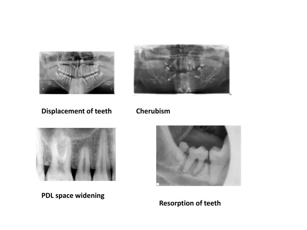 displacement of teeth