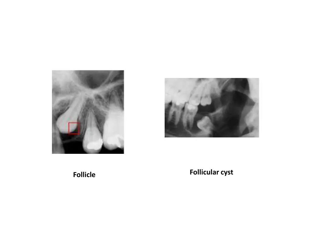 follicular cyst