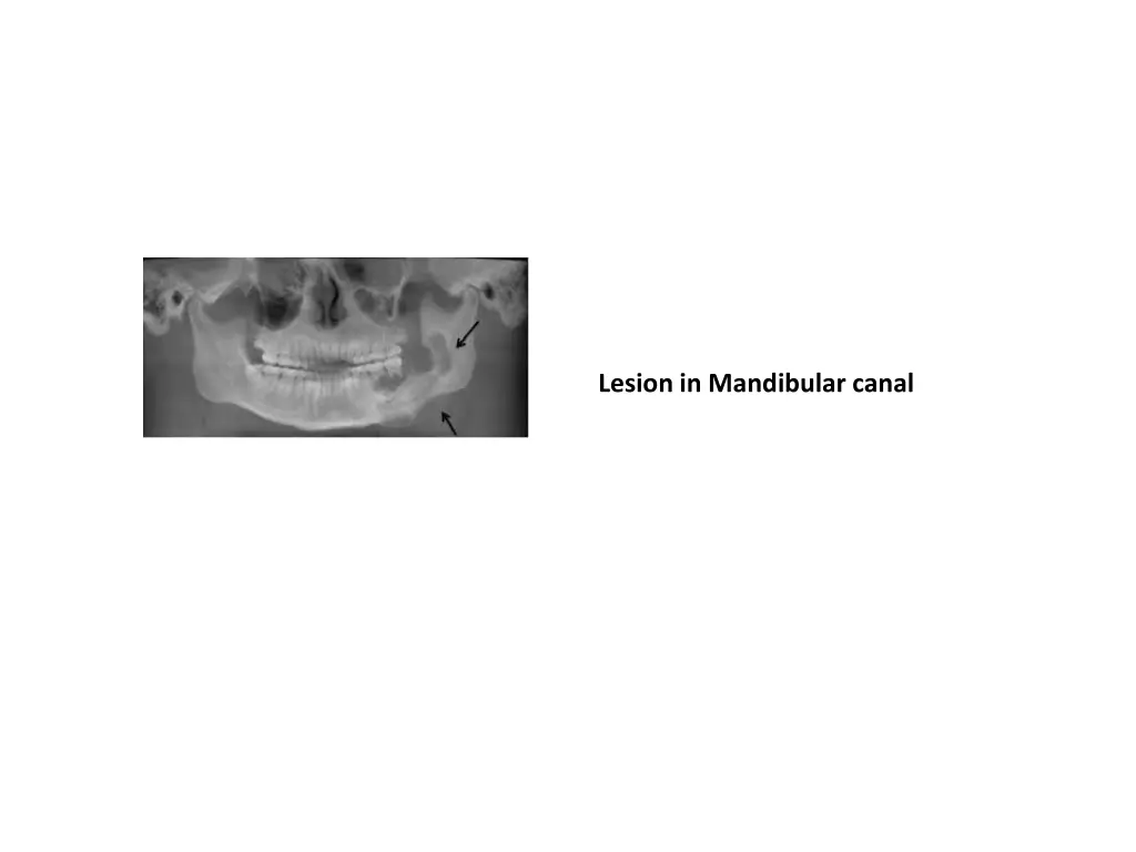lesion in mandibular canal