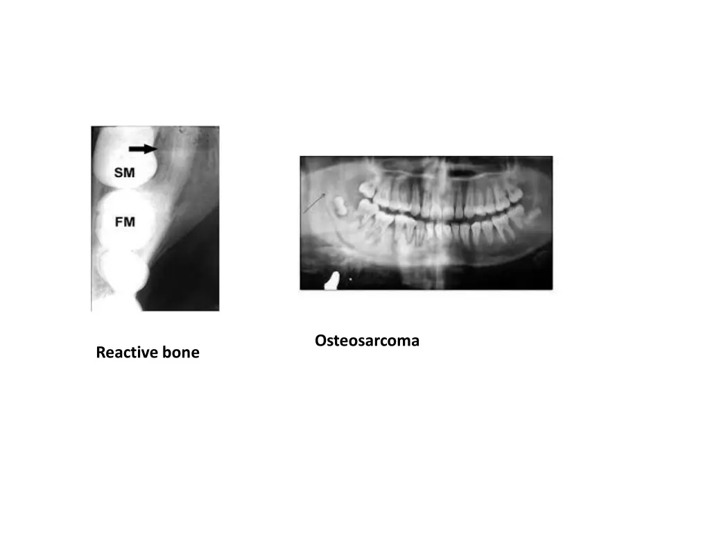 osteosarcoma