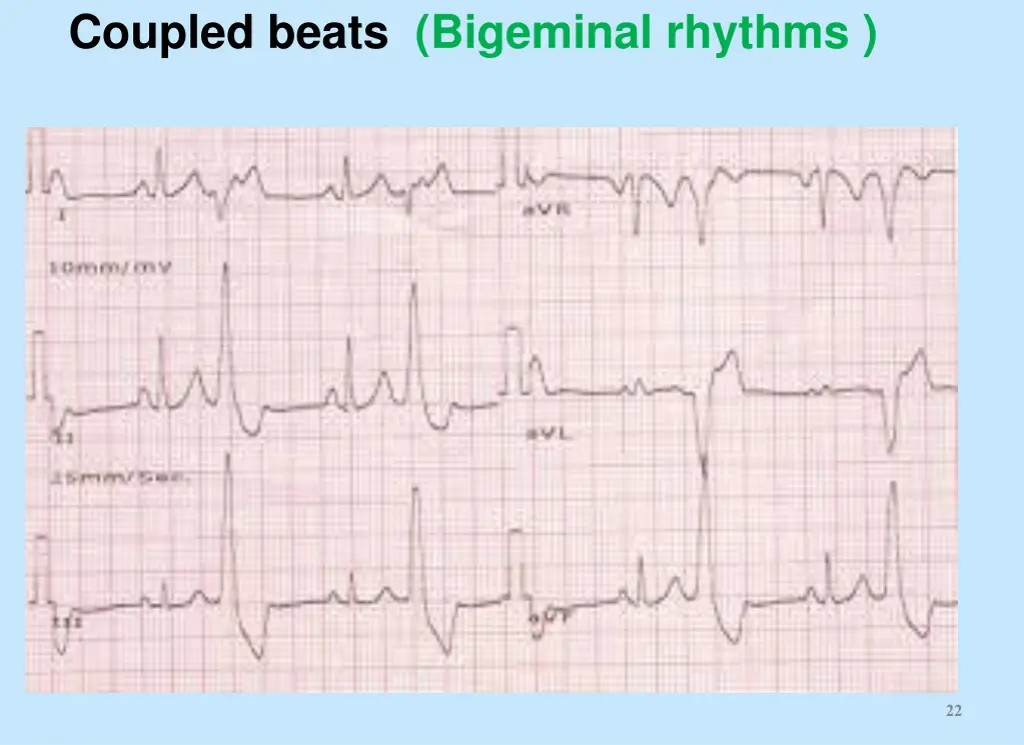 coupled beats bigeminal rhythms
