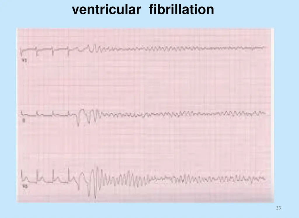 ventricular fibrillation