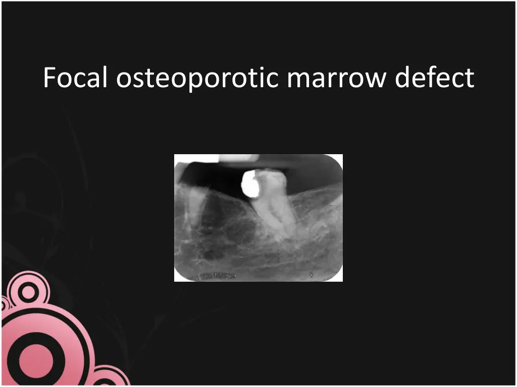 focal osteoporotic marrow defect