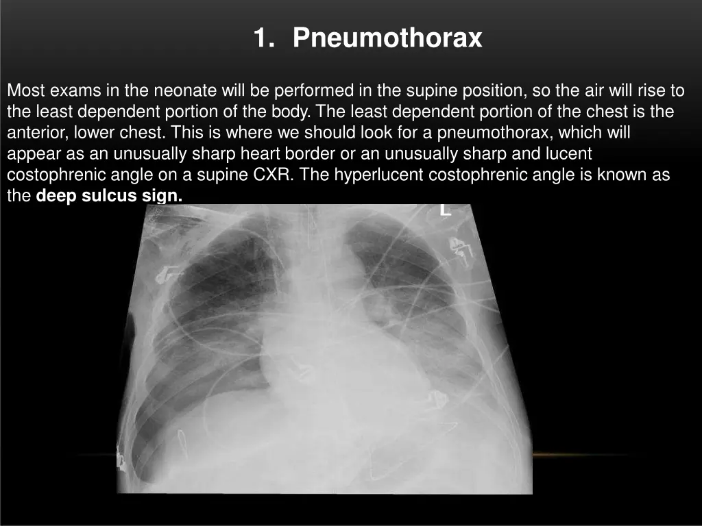 1 pneumothorax