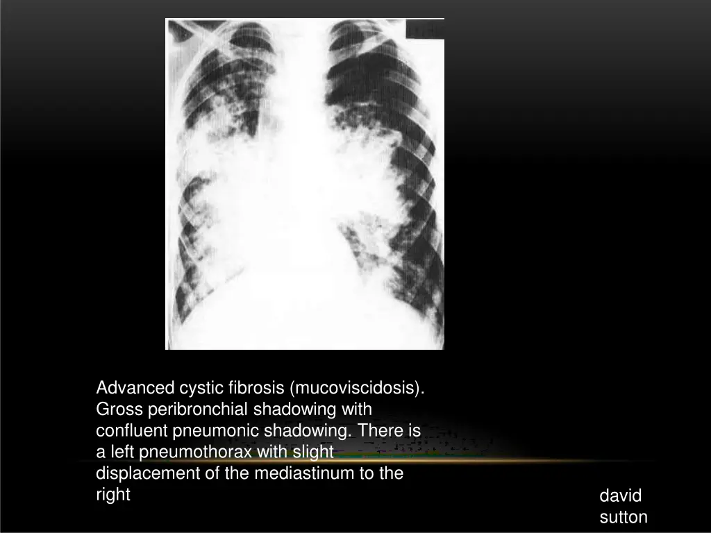 advanced cystic fibrosis mucoviscidosis gross