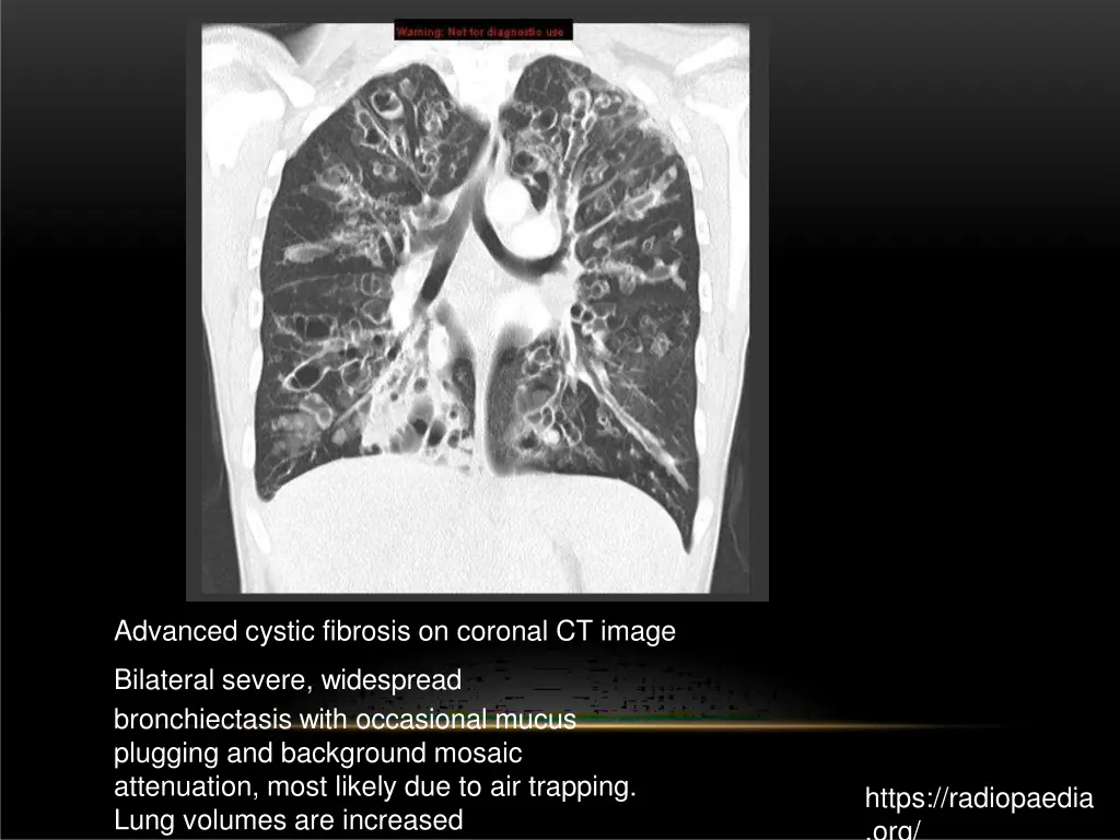 advanced cystic fibrosis on coronal ct image