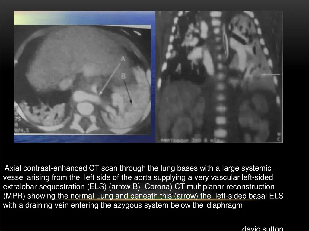 axial contrast enhanced ct scan through the lung